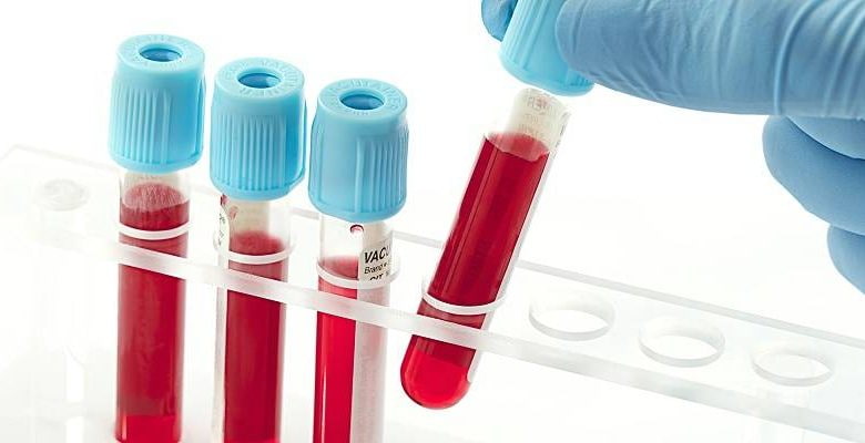 کیت غربالگری سکته قلبی برای آزمایشگاه به صورت عمده و سفارش آنلاین